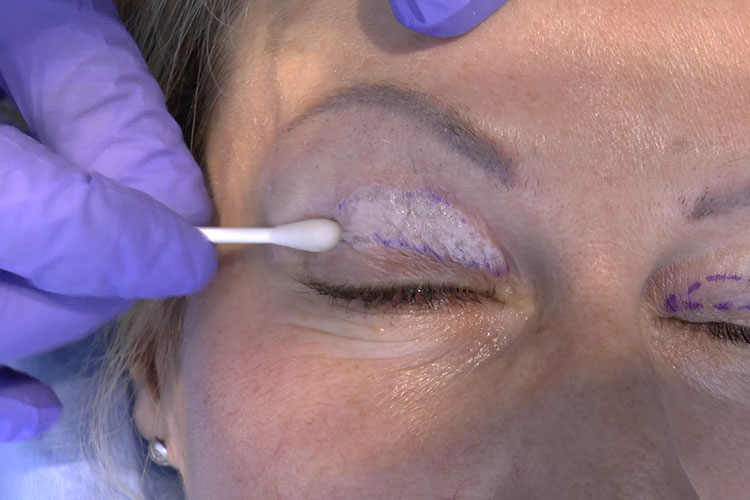 non-ablative blepharoplasty by means of mixed peeling 0.5